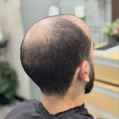 Antes da prótese capilar - coroa